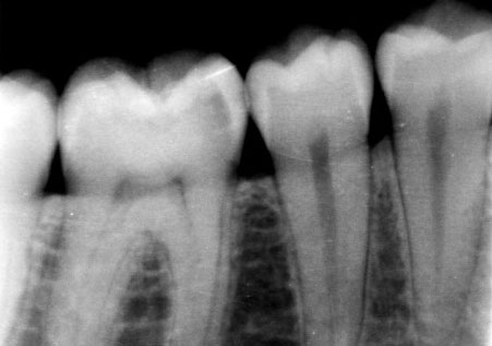 Radiografía periapical