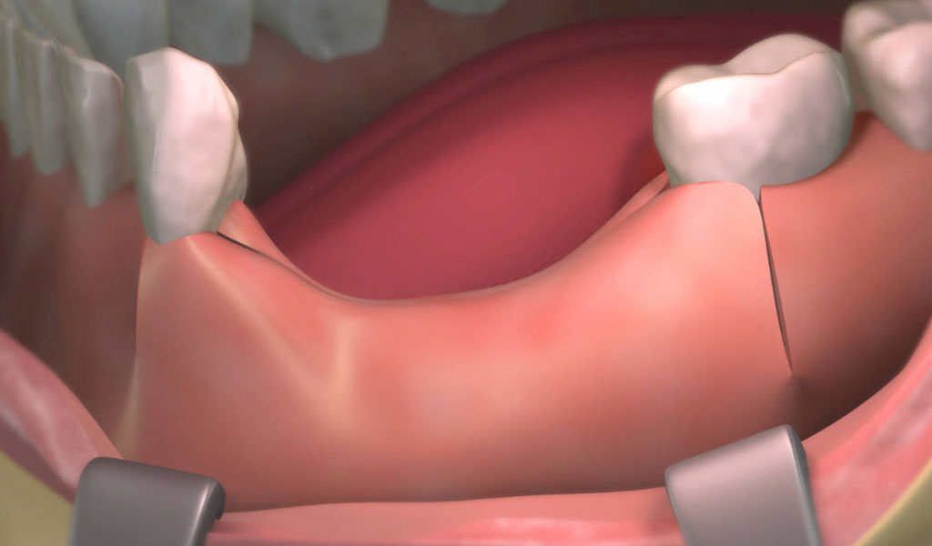 pérdida hueso dental