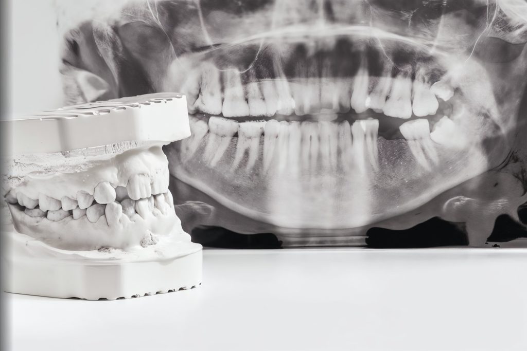Osteotomía dental