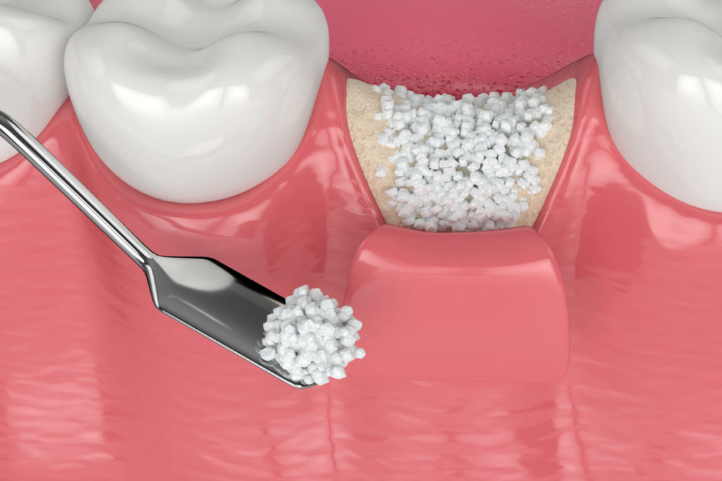 rechazo de injerto de hueso dental
