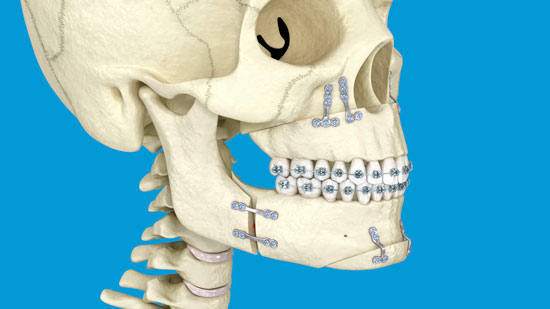 osteotomia dental