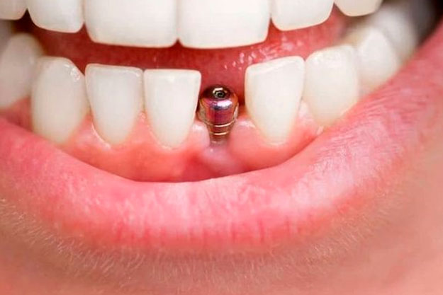 postoperatorio cirugia implantes dentales