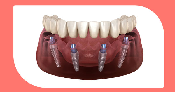 implantes All-on-four