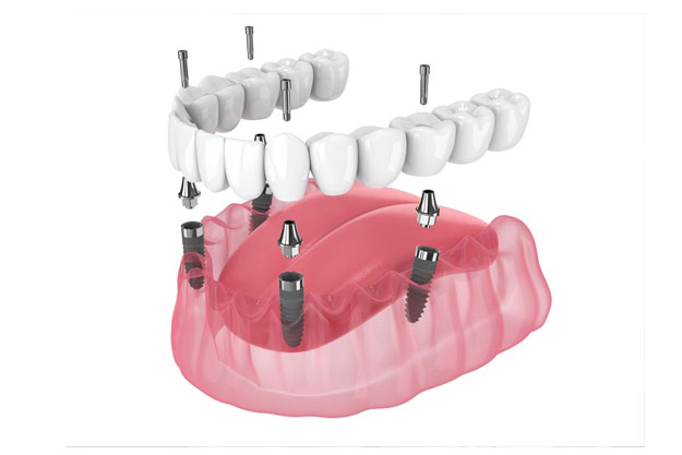implantes All-on-four