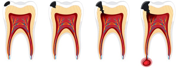 formacion de pulpitis (nervio dental inflamado)