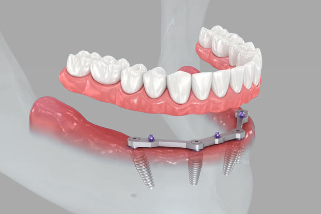 protesis fija con implantes all-on-4